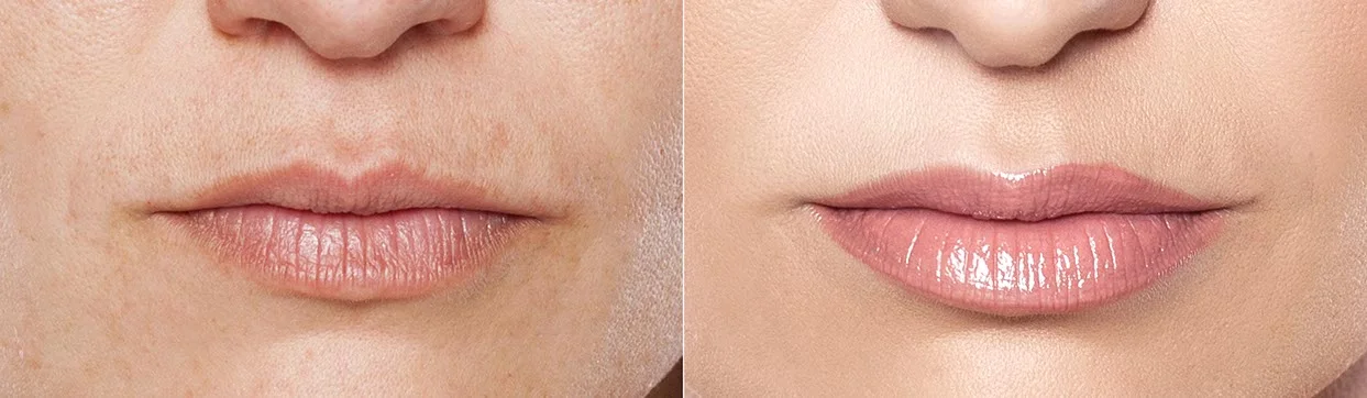 Lippen-Permanent-Make-up vor und nach der Behandlung